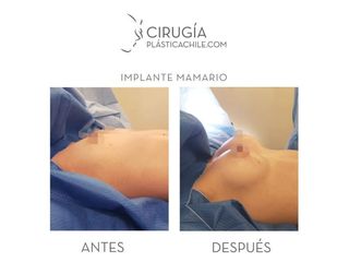 Aumento mamario - Dr. Gustavo Rene Sotillo Ochoa
