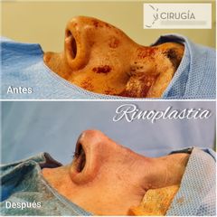 Rinoplastia - Dr. Gustavo Rene Sotillo Ochoa
