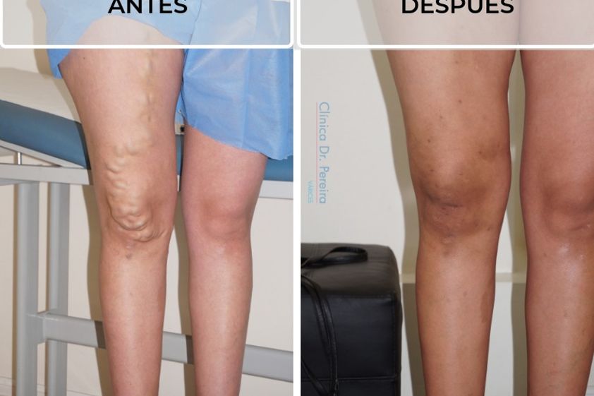 Tratamiento de várices antes y después - 638570