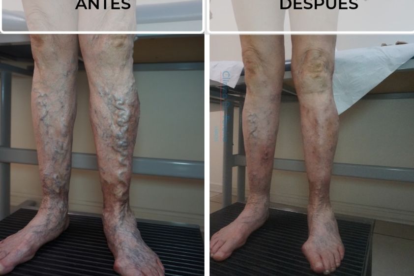 Tratamiento de várices antes y después - 638572