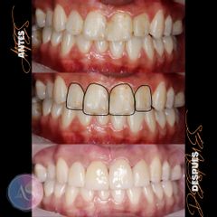 Implantes dentales - Art & Smile