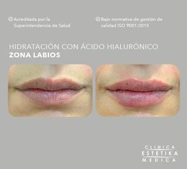 Aumento de labios - Clínica Estetika Médica