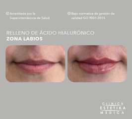 Aumento de labios - Clínica Estetika Médica