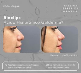 Rinolips - Clínica Estetika Médica
