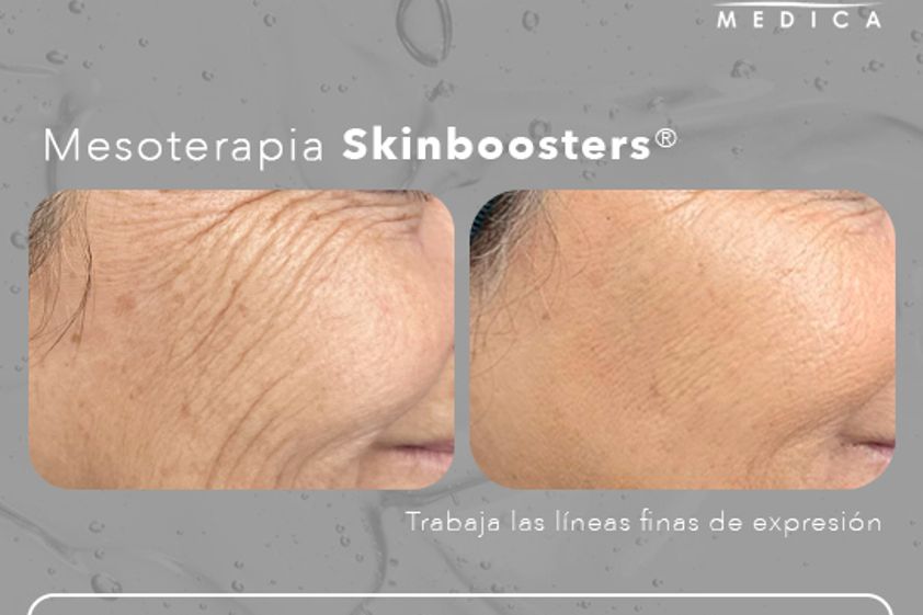 Mesoterapia antes y después - 856515