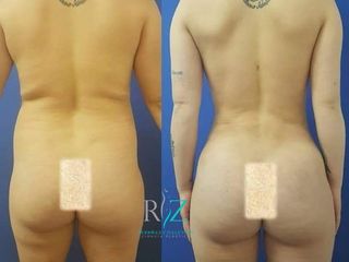Lipoescultura con transferencia a glúteos