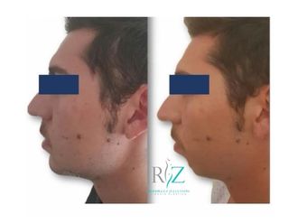 Mentoplastia - 637346