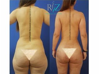 LIPOESCULTURA