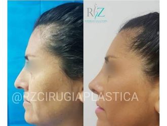 Rinoplastia - 637350