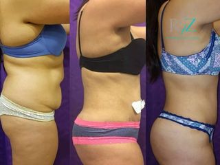 Lipoabdominoplastia