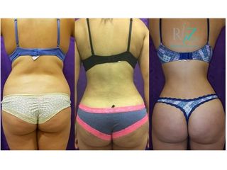 Lipoabdominoplastia más lipotransferencia glutea