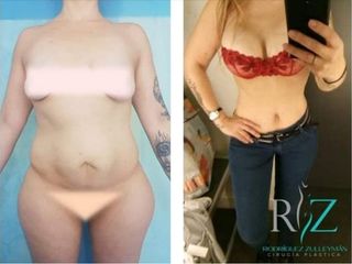 Lipoabdominoplastia, implante mamario y pexia