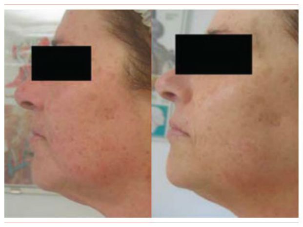 Microdermoabrasión Antes y después - Clinicasesteticas.cl