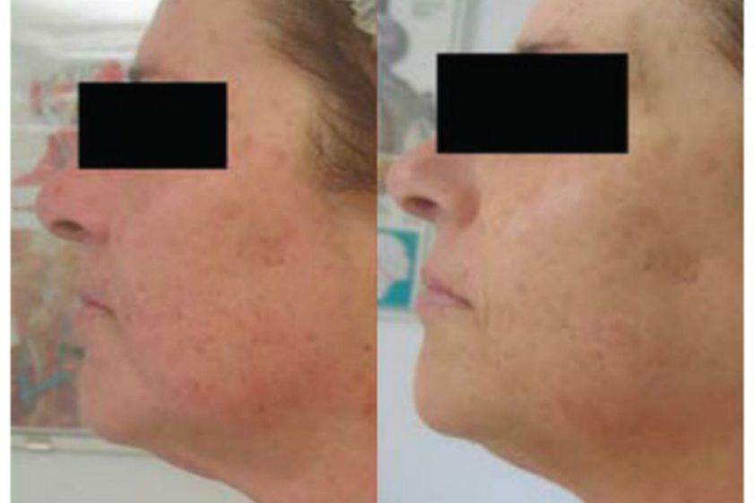 Microdermoabrasión antes y después - 501767