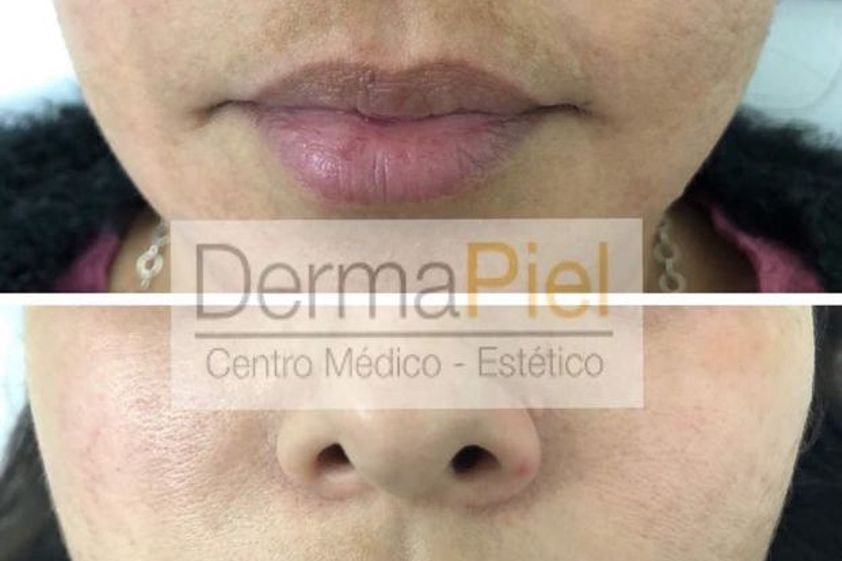Peeling antes y después - 629777