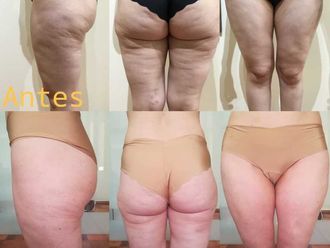 Carboxiterapia - 636020