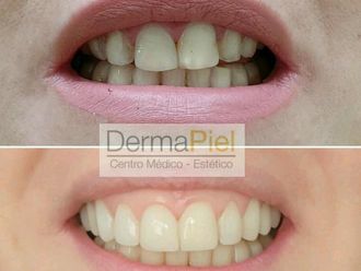 Carillas de porcelana - 638257