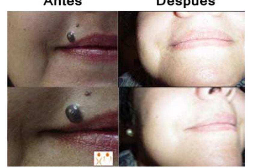Lunares antes y después - 498469