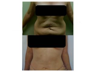 Abdominoplastia