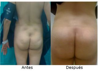 Aumento de glúteos