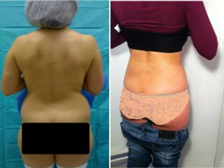Lipoescultura
