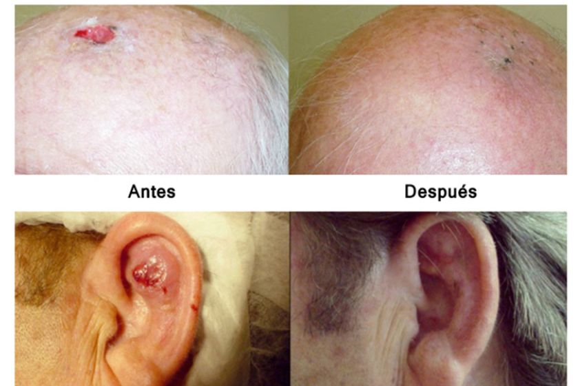 Psoriasis antes y después - 498532