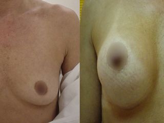 Antes y despues de implante mamario
