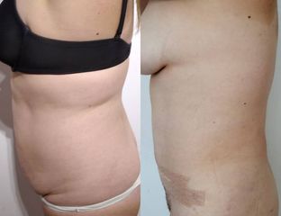 Abdominoplastia - Dr Nicolas Adriazola