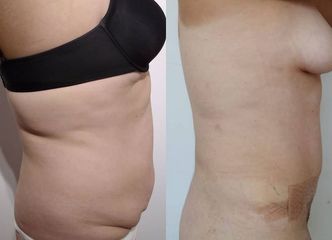 Abdominoplastia - Dr Nicolas Adriazola