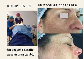 Rinoplastia - Dr Nicolas Adriazola