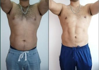 Liposucción - Dr Nicolas Adriazola
