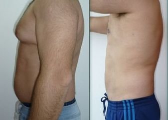 Liposucción - Dr Nicolas Adriazola