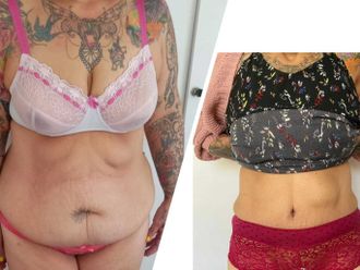 Abdominoplastia - 799759