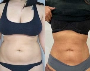Liposucción - Dr Nicolas Adriazola