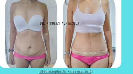 Abdominoplastia - Dr Nicolas Adriazola