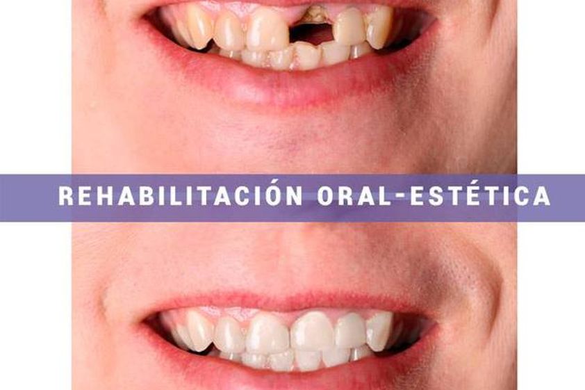 Implantes dentales antes y después - 573505