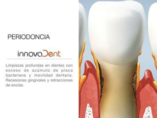 Periodoncia