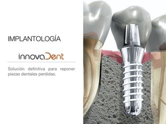 Implantes dentales-609687