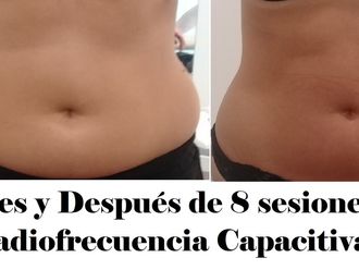 Masaje reductivo antes y después - 636371