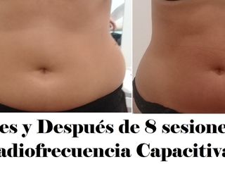 Tratamientos Reductivos con Radiofrecuencia y Crío.