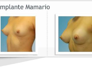 Antes y despues de aumento mamario
