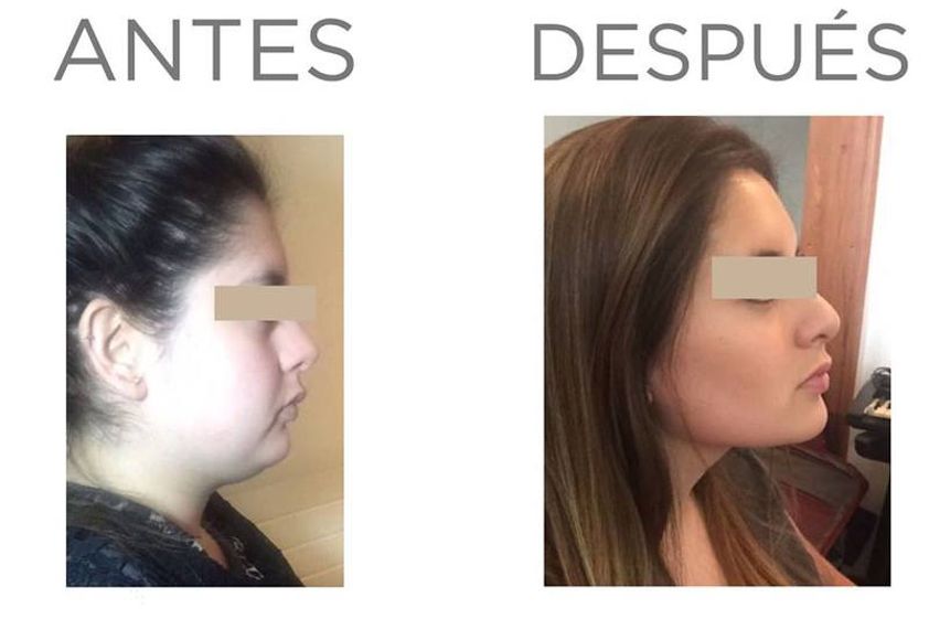 Bolas de Bichat antes y después - 642429