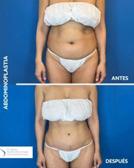 Abdominoplastia - Dr. Sergio Valenzuela U
