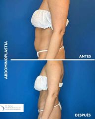 Abdominoplastia - Dr. Sergio Valenzuela U