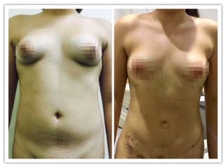 Lipoescultura