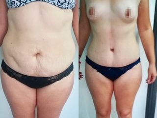 Lipoescultura + abdominoplastia
