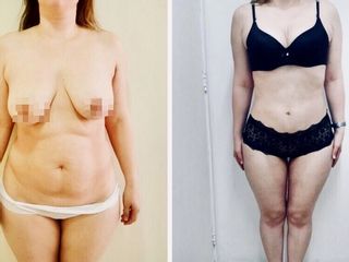 Lipoescultura + abdominoplastia