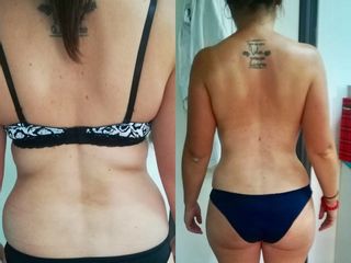 Lipoescultura + abdominoplastia 