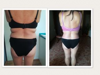 Lipoescultura + abdominoplastia 