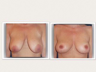 Mastopexia reductiva
